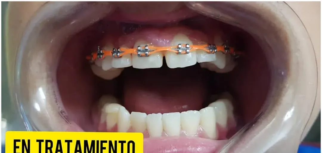 Ortodoncia en tratamiento: en tratamiento