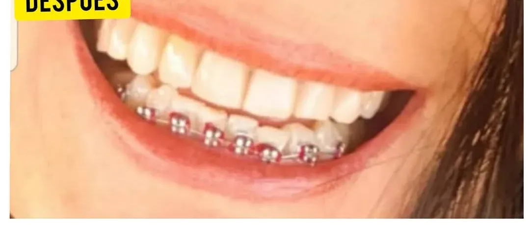 Cerrar los espacios con brackets: después