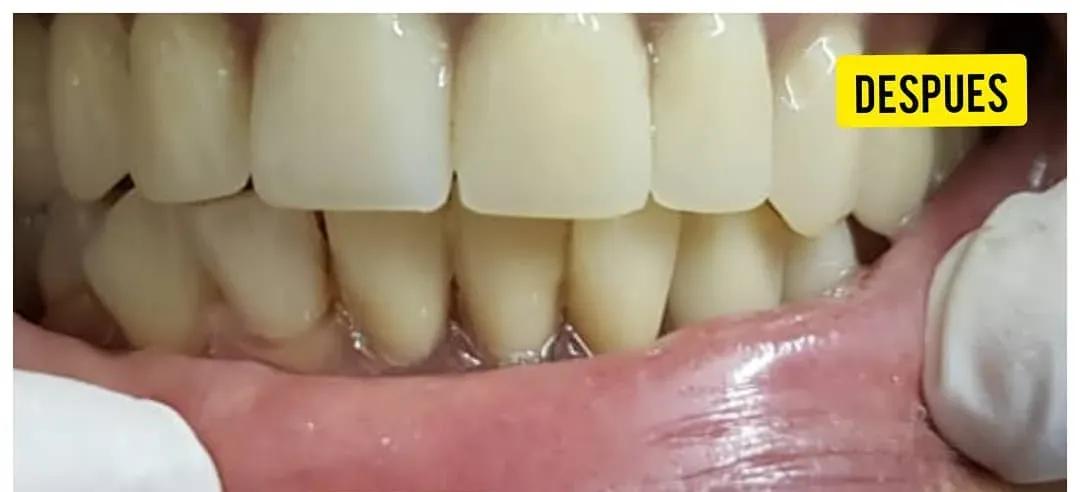 Completar una sonrisa incompleta: después
