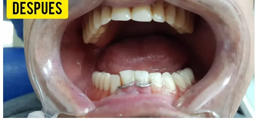 Volver a tener los dientes de adelante: después