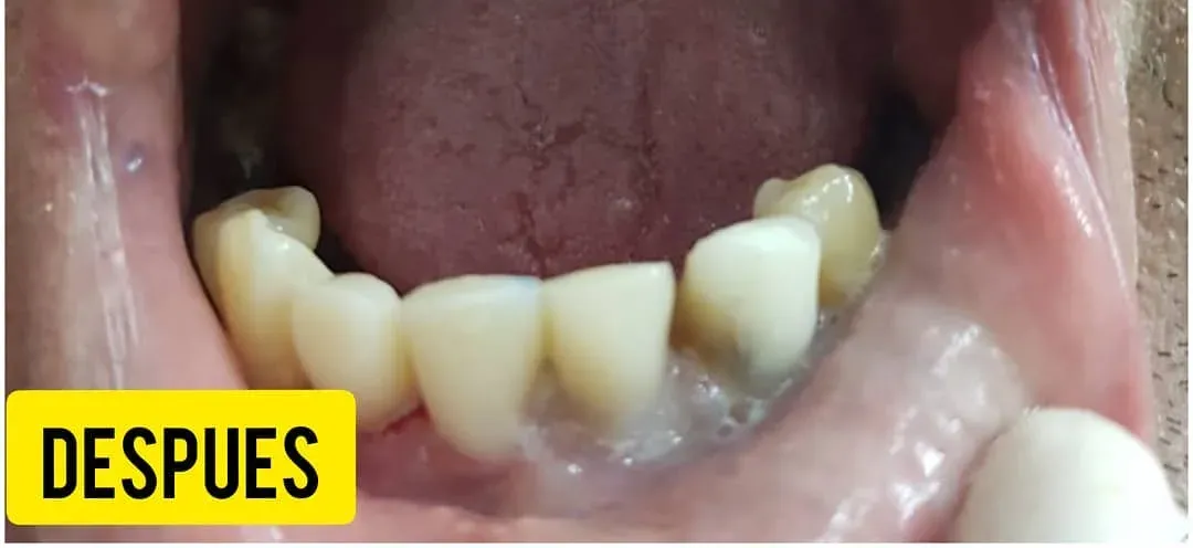Rehabilitación de los dientes de abajo: después